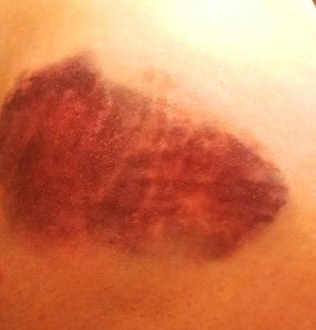 The next morning- this was the bruise on my ass.  